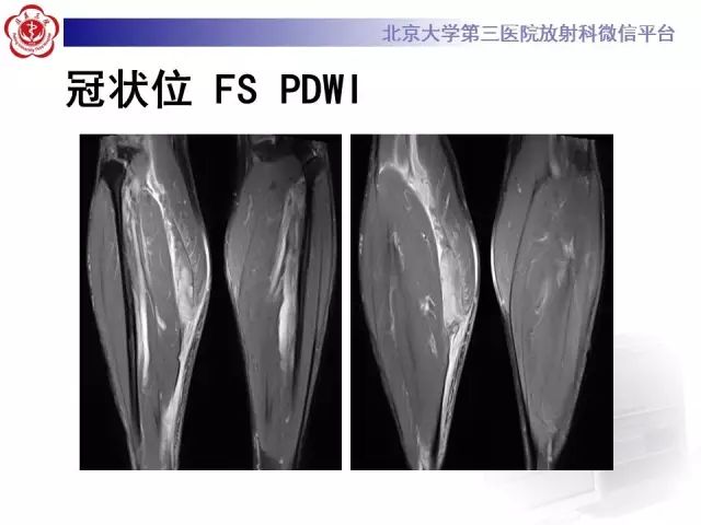 【病例】网球腿1例MR影像诊断