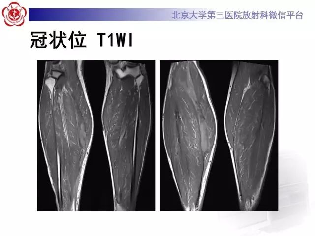 【病例】网球腿1例MR影像诊断
