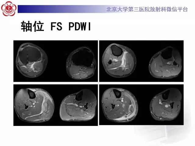 【病例】网球腿1例MR影像诊断