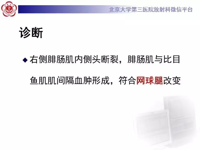 【病例】网球腿1例MR影像诊断