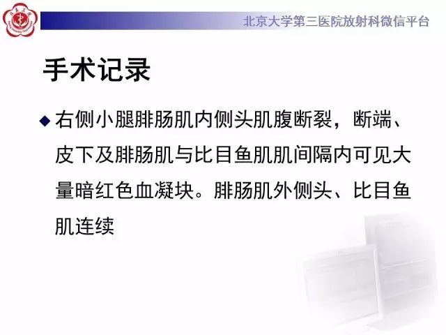 【病例】网球腿1例MR影像诊断