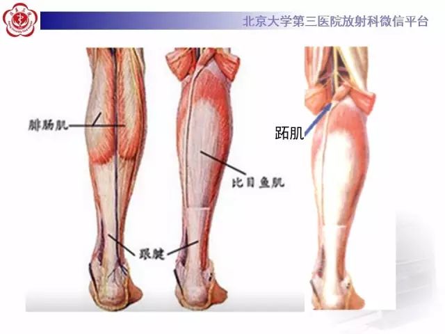 【病例】网球腿1例MR影像诊断