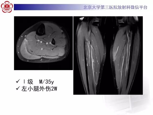 【病例】网球腿1例MR影像诊断