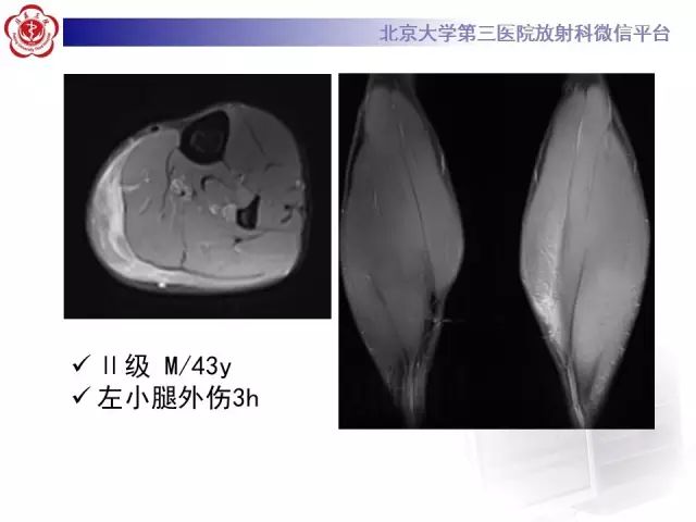 【病例】网球腿1例MR影像诊断