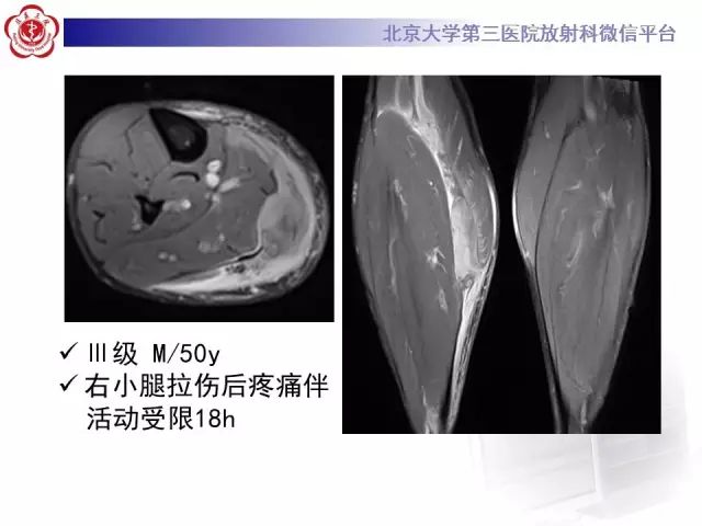 【病例】网球腿1例MR影像诊断