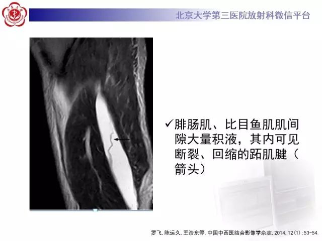 【病例】网球腿1例MR影像诊断