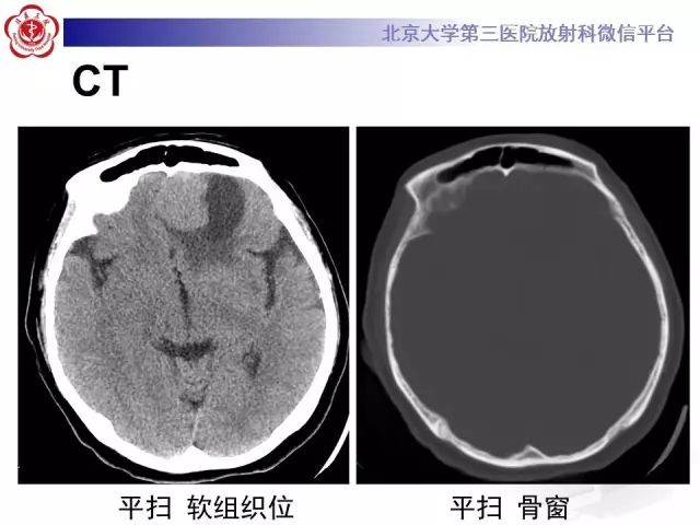 【病例】囊性脑膜瘤1例CT及MR影像诊断