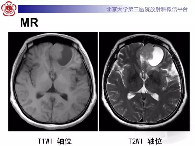 【病例】囊性脑膜瘤1例CT及MR影像诊断