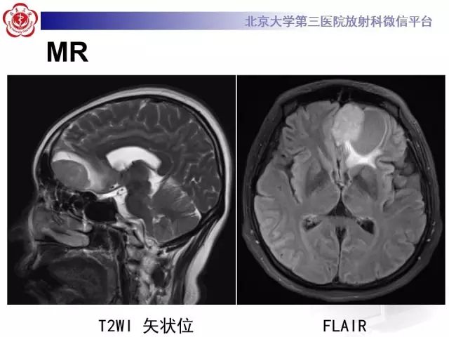 【病例】囊性脑膜瘤1例CT及MR影像诊断