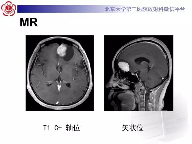 【病例】囊性脑膜瘤1例CT及MR影像诊断