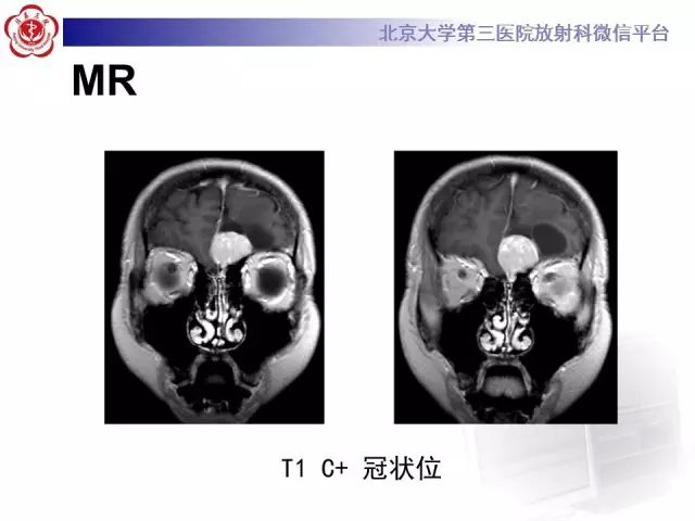 【病例】囊性脑膜瘤1例CT及MR影像诊断