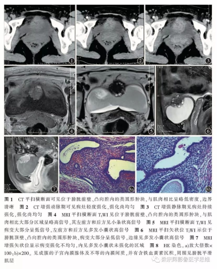 【病例】膀胱壁子宫内膜异位症1例CT及MR影像诊断思维
