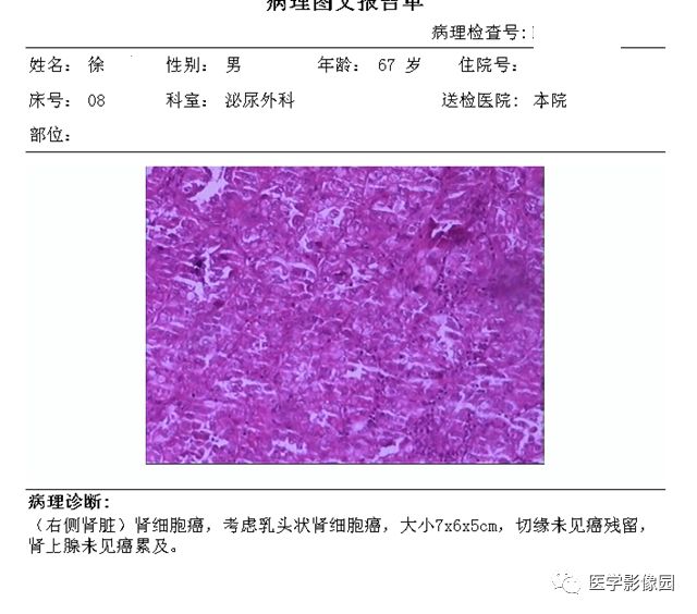 【病例】肾脏乳头状肾细胞癌1例CT影像表现 【病例】肾脏乳头状肾细胞癌1例CT影像表现