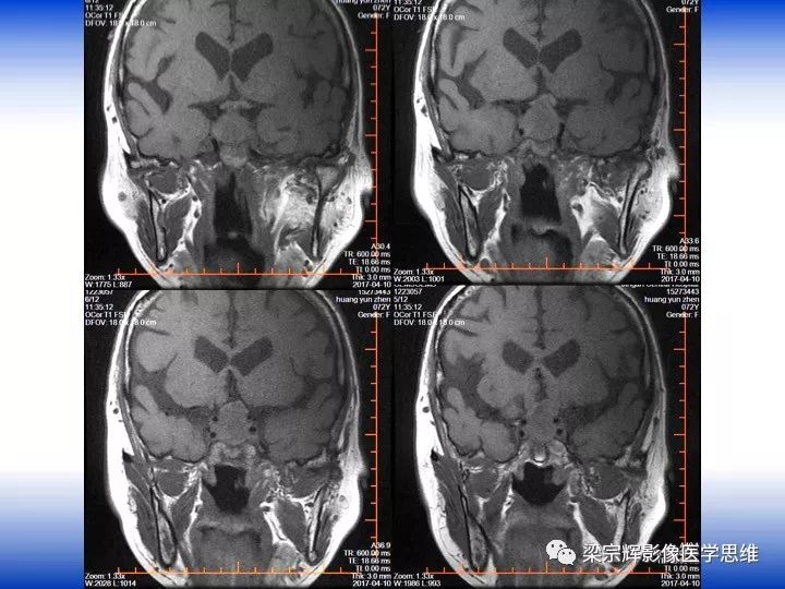 【病例】垂体脓肿1例MR影像表现