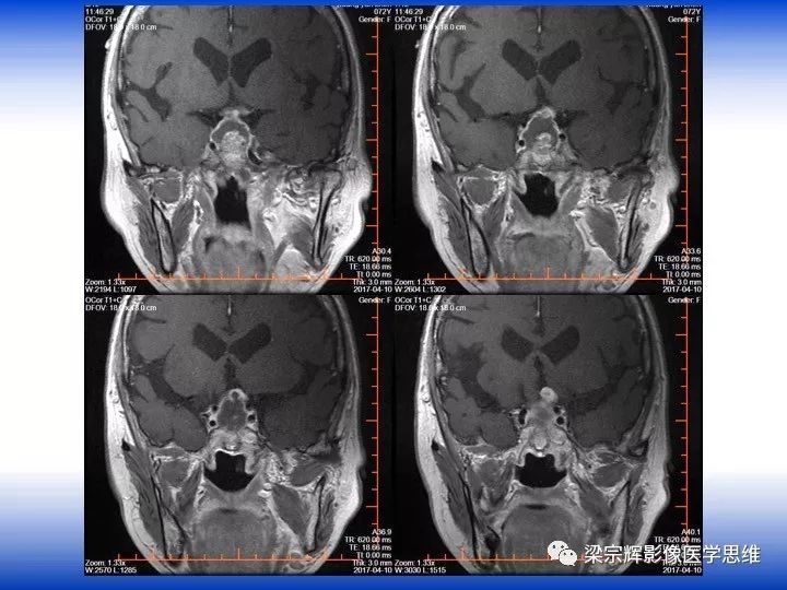 【病例】垂体脓肿1例MR影像表现