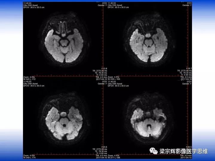 【病例】垂体脓肿1例MR影像表现