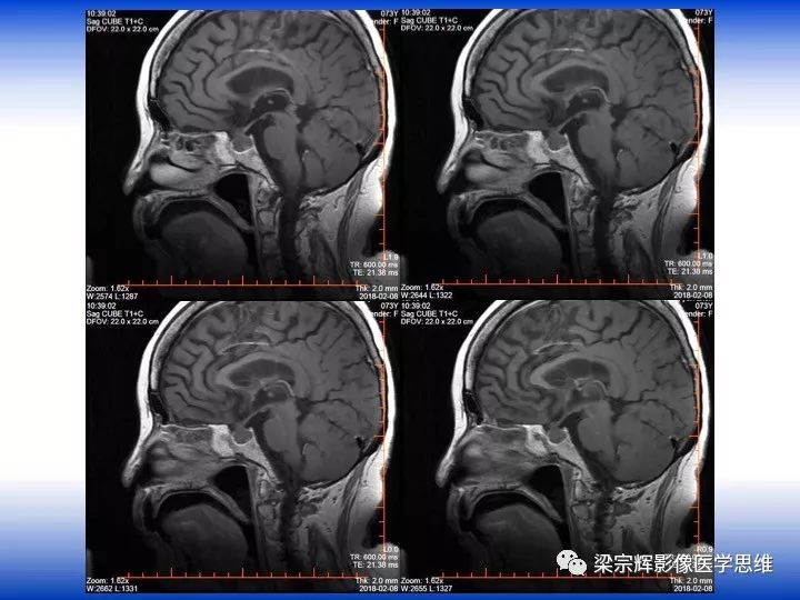 【病例】垂体脓肿1例MR影像表现