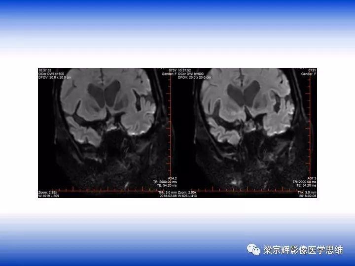 【病例】垂体脓肿1例MR影像表现