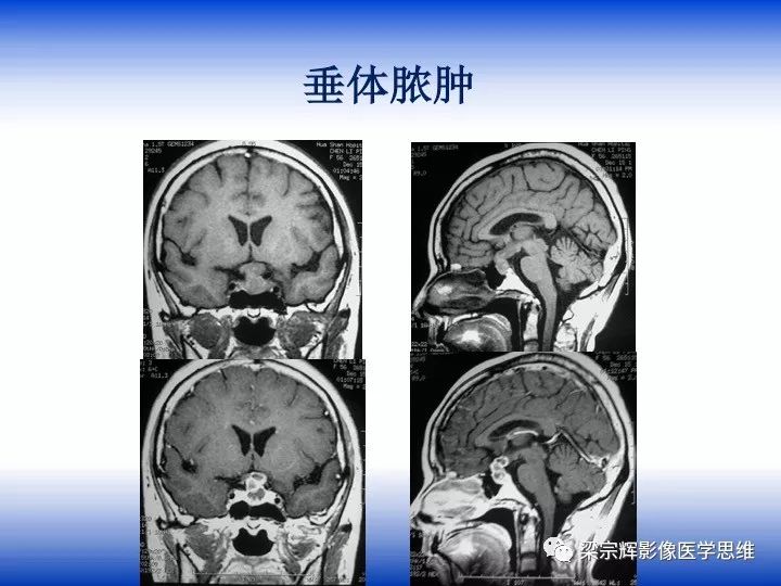 【病例】垂体脓肿1例MR影像表现