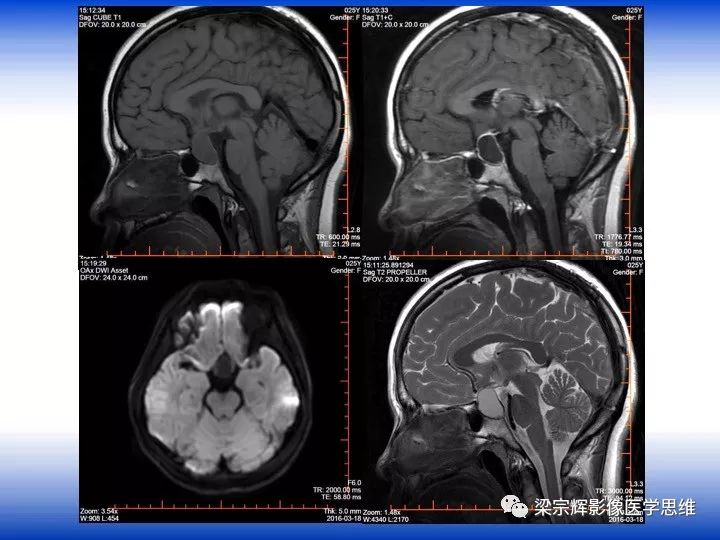 【病例】垂体脓肿1例MR影像表现