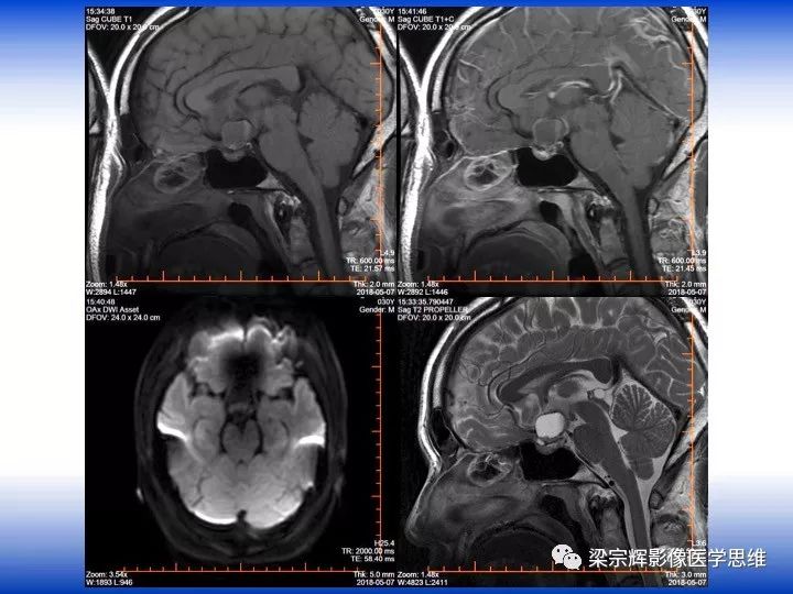 【病例】垂体脓肿1例MR影像表现