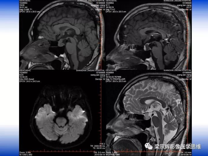 【病例】垂体脓肿1例MR影像表现