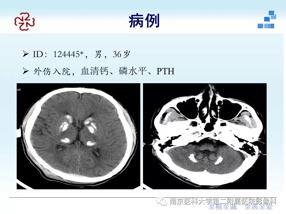 【PPT】Fahr病的影像学表现