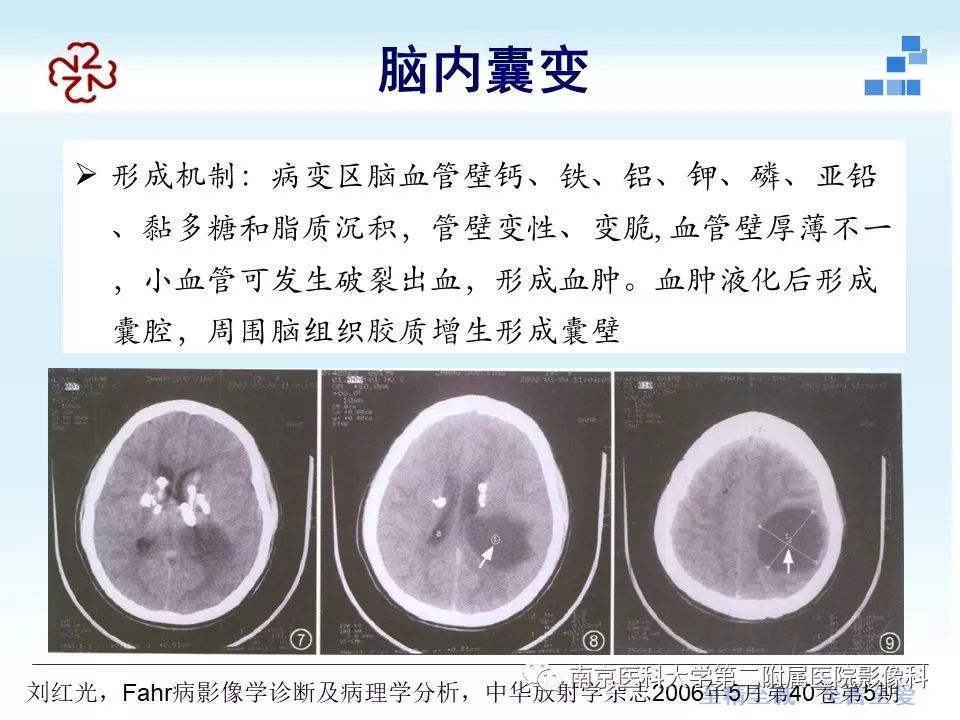 【PPT】Fahr病的影像学表现