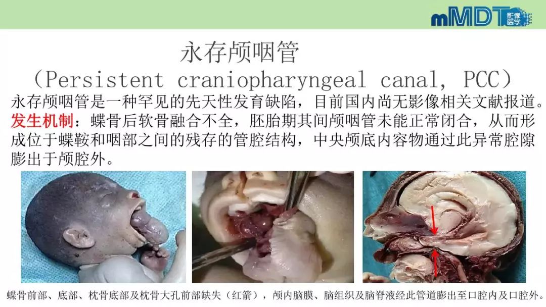 【PPT】永存颅咽管的影像表现