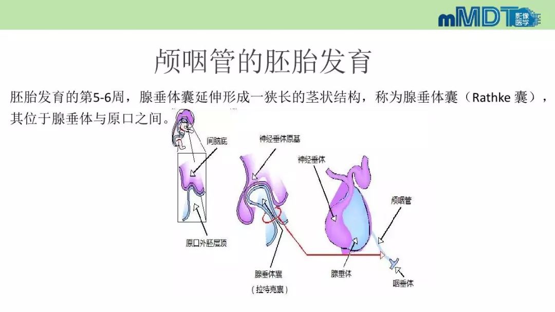 【PPT】永存颅咽管的影像表现