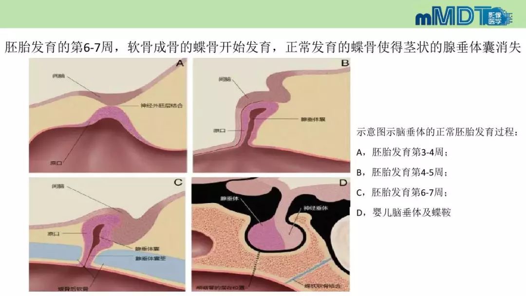 【PPT】永存颅咽管的影像表现