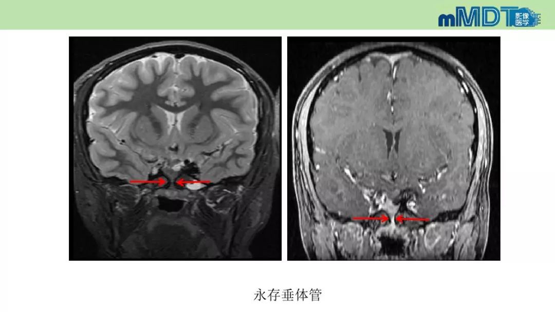 【PPT】永存颅咽管的影像表现