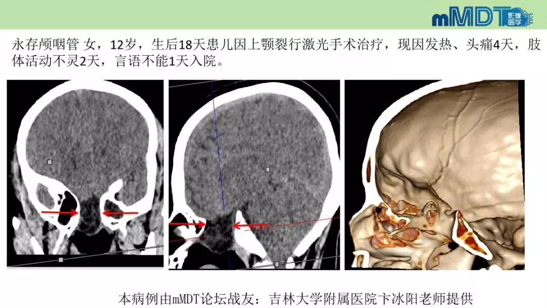 【PPT】永存颅咽管的影像表现