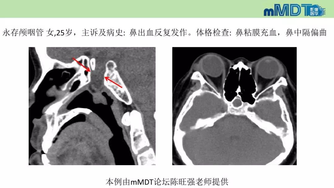 【PPT】永存颅咽管的影像表现