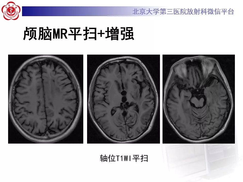 【病例】基底节区生殖细胞瘤1例MR影像