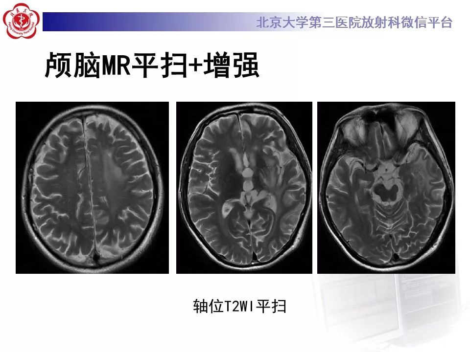 【病例】基底节区生殖细胞瘤1例MR影像