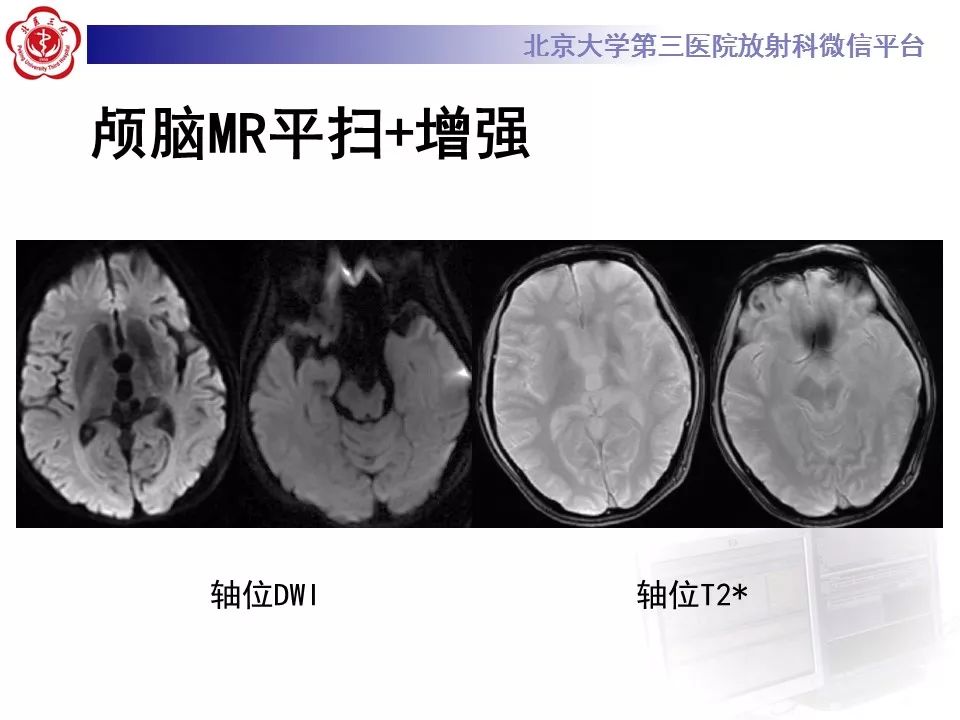 【病例】基底节区生殖细胞瘤1例MR影像