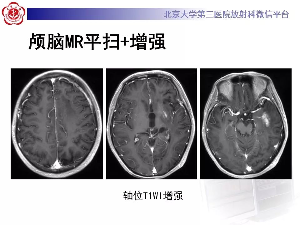 【病例】基底节区生殖细胞瘤1例MR影像