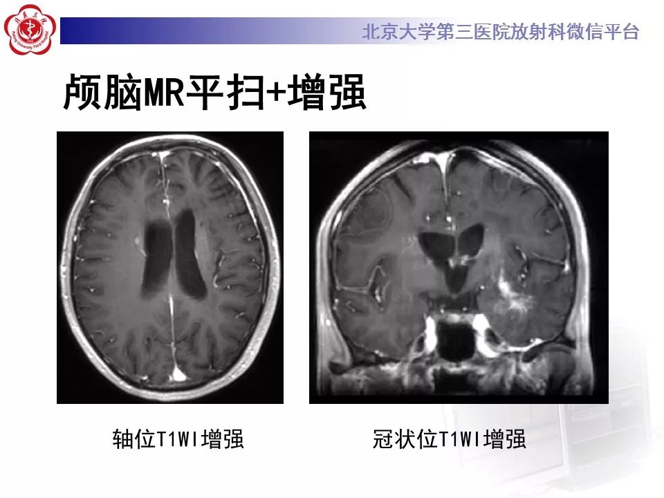【病例】基底节区生殖细胞瘤1例MR影像
