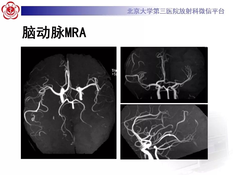 【病例】基底节区生殖细胞瘤1例MR影像