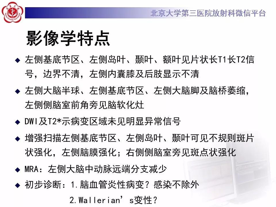 【病例】基底节区生殖细胞瘤1例MR影像