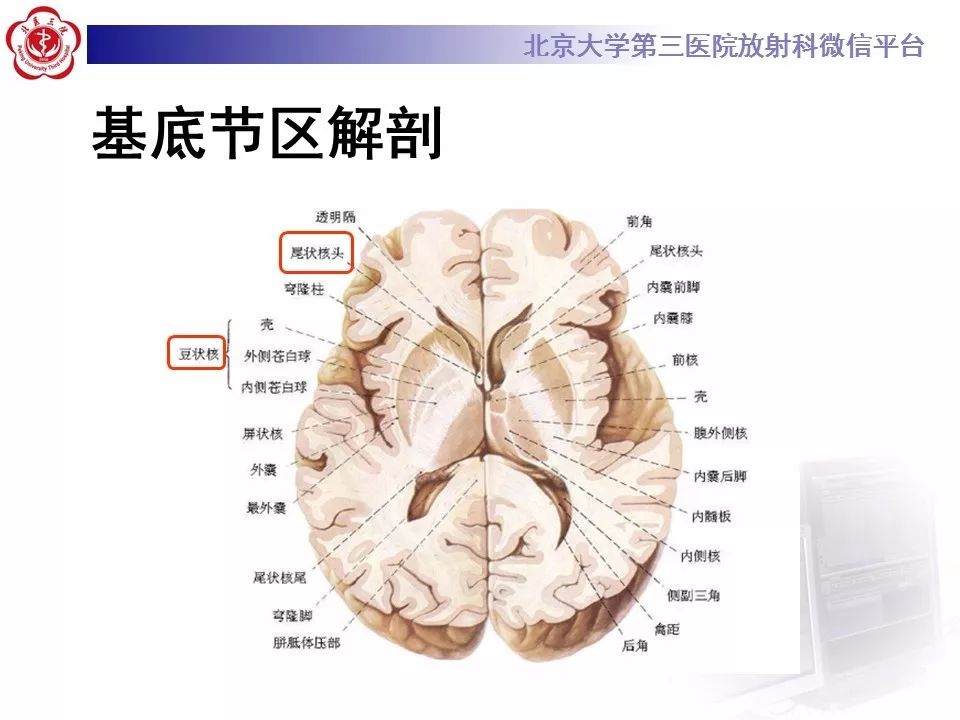 【病例】基底节区生殖细胞瘤1例MR影像