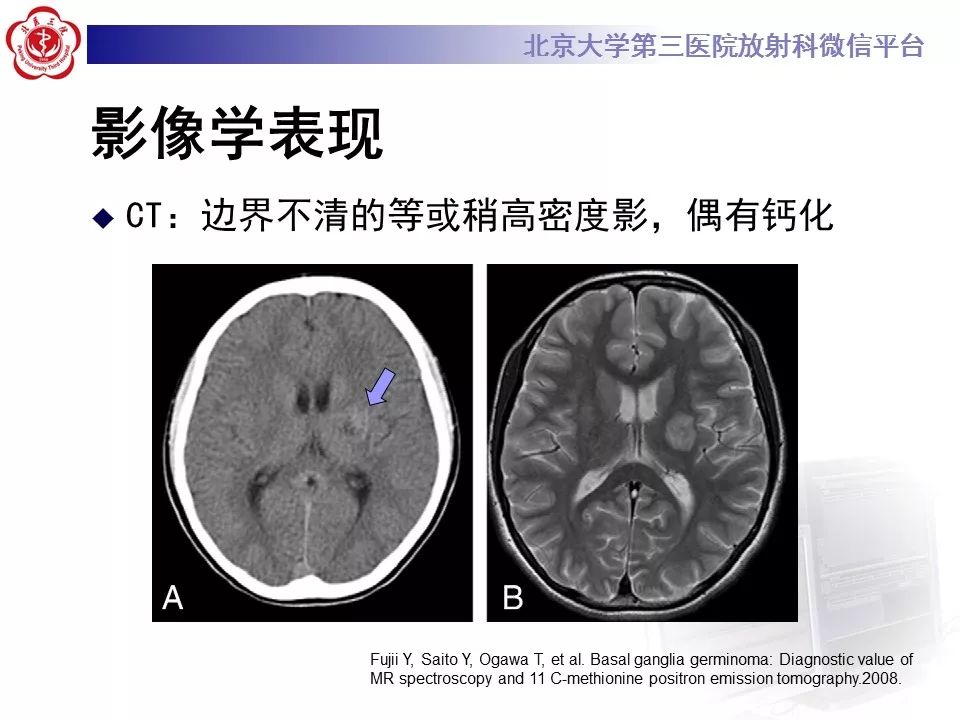 【病例】基底节区生殖细胞瘤1例MR影像