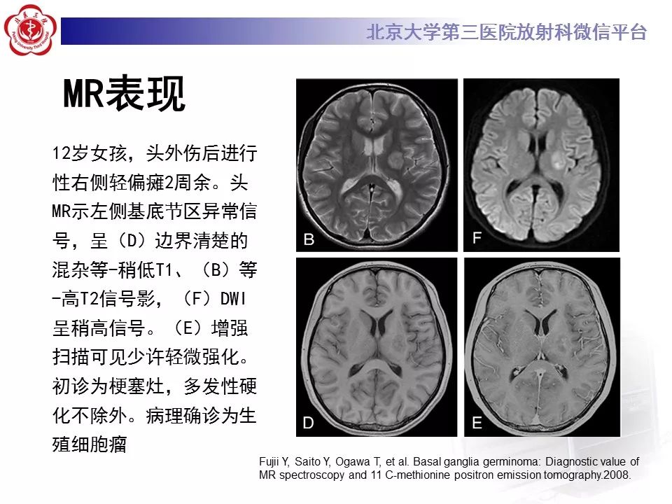 【病例】基底节区生殖细胞瘤1例MR影像
