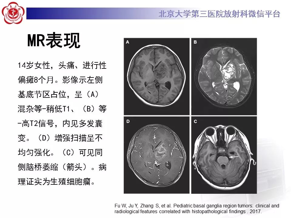 【病例】基底节区生殖细胞瘤1例MR影像