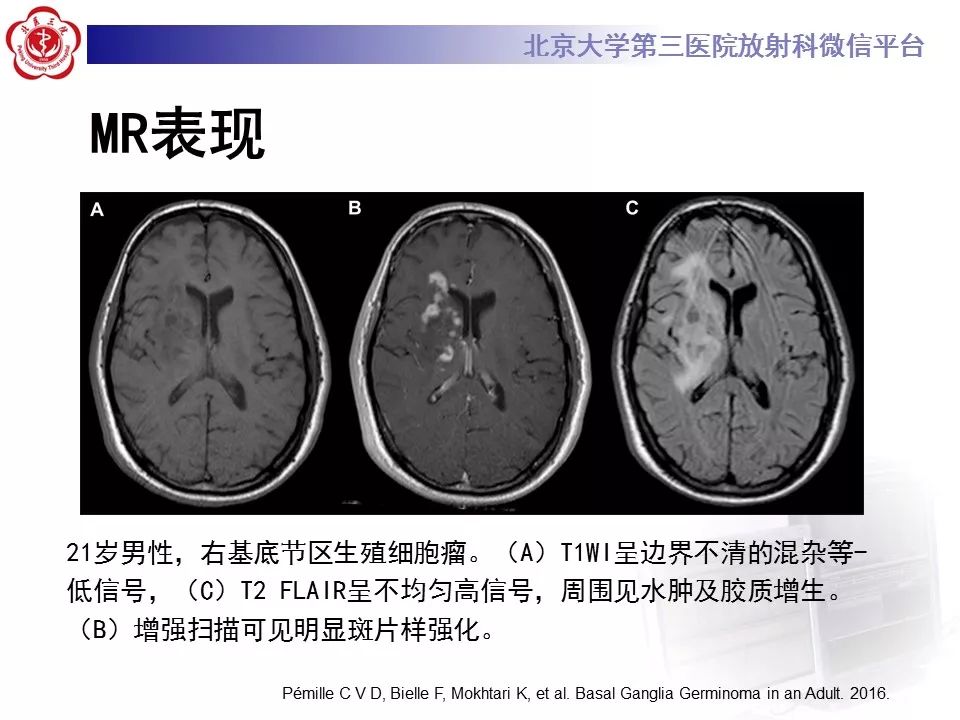 【病例】基底节区生殖细胞瘤1例MR影像