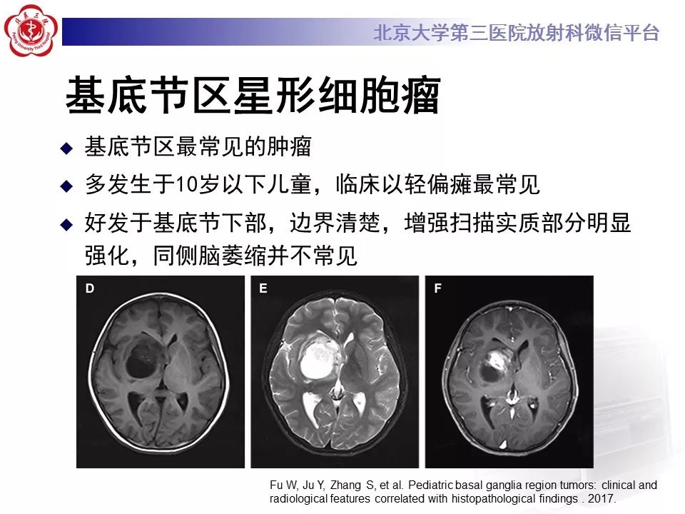 【病例】基底节区生殖细胞瘤1例MR影像
