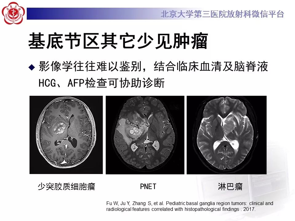 【病例】基底节区生殖细胞瘤1例MR影像
