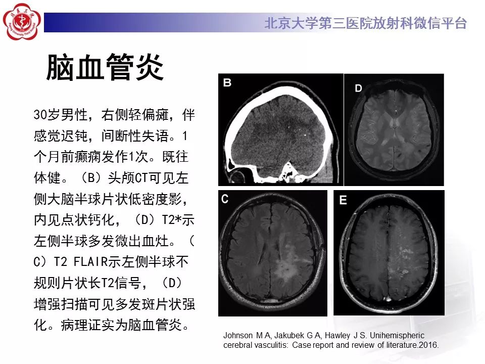 【病例】基底节区生殖细胞瘤1例MR影像