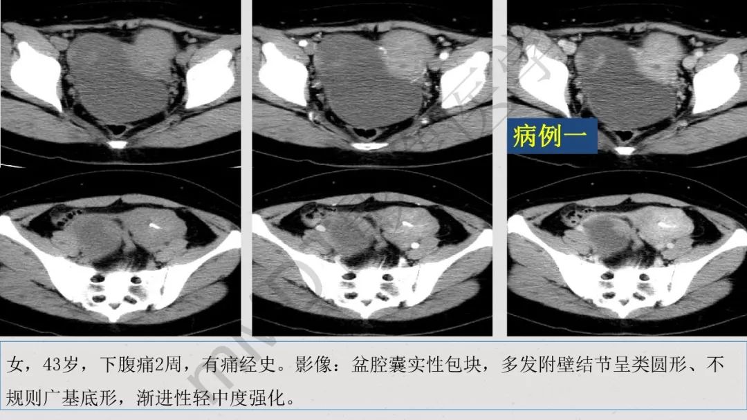 【PPT】卵巢透明细胞癌影像诊断